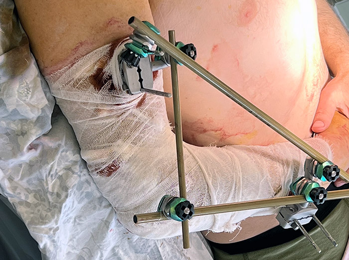 FIXATOR FRAME... The soldier who was treated by trauma surgeon Andy Kent in Ukraine...
